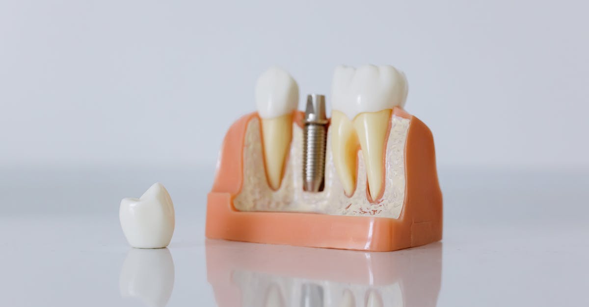 How long do single tooth implants last?