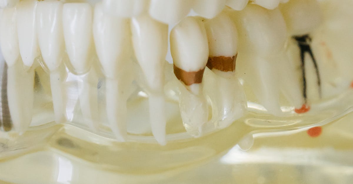 What will the dentist do if all my teeth are decaying?